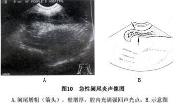 急性阑尾炎